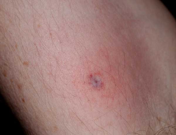 What should you do if a tick burrows under your skin ...
